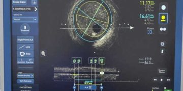 Innovation médicale : première implantation en Afrique d’un stent biodégradable à La Rabta